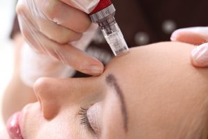 Mesotherapy Q&A. Everything you need to know about the treatment