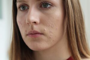 No more spots! How to get rid of acne?