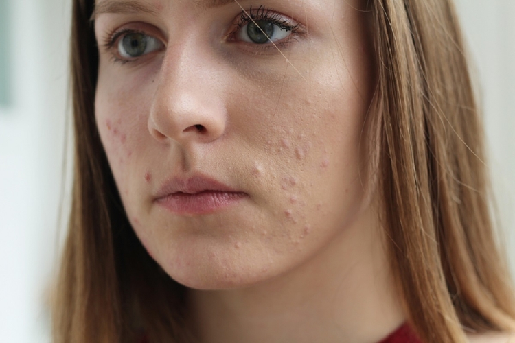 no-more-spots-how-to-get-rid-of-acne